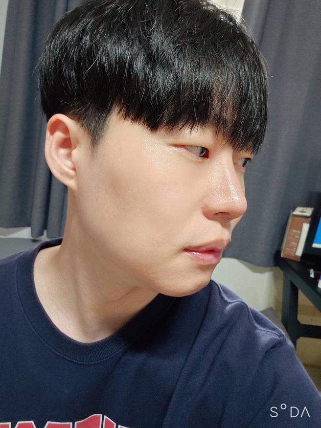 안심 코 재수술