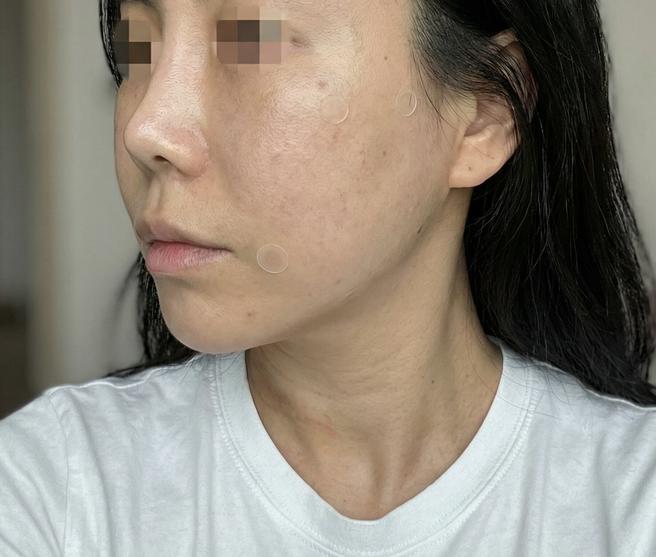 Ultherapy 音波拉提 600發