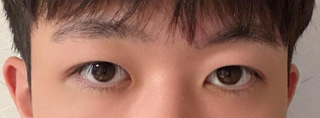 男性目元矯正