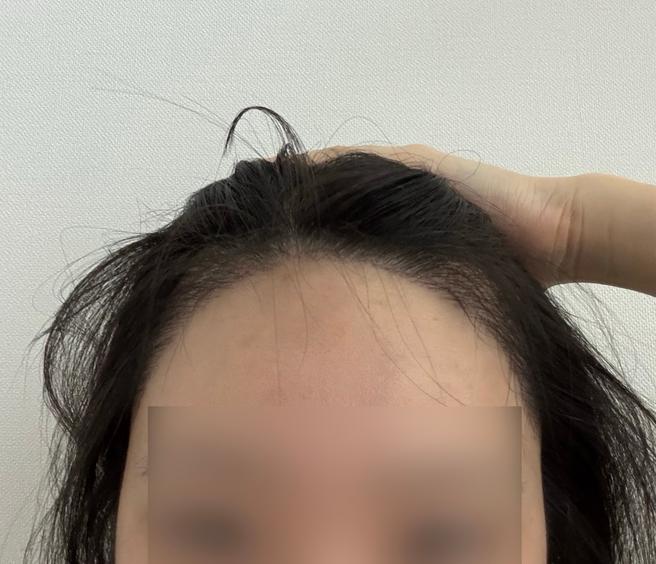 ソウルアイ毛髪移植