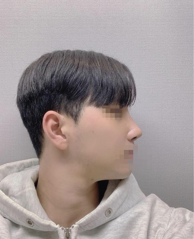 男性隆鼻术