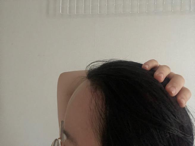額頭縮小