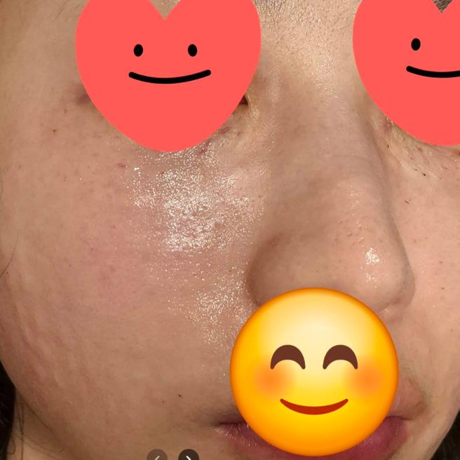 서울아이성형외과 수면 리쥬란 2일차 경과 올려요!