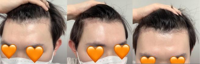 Hair Loss Treatment in Seoul