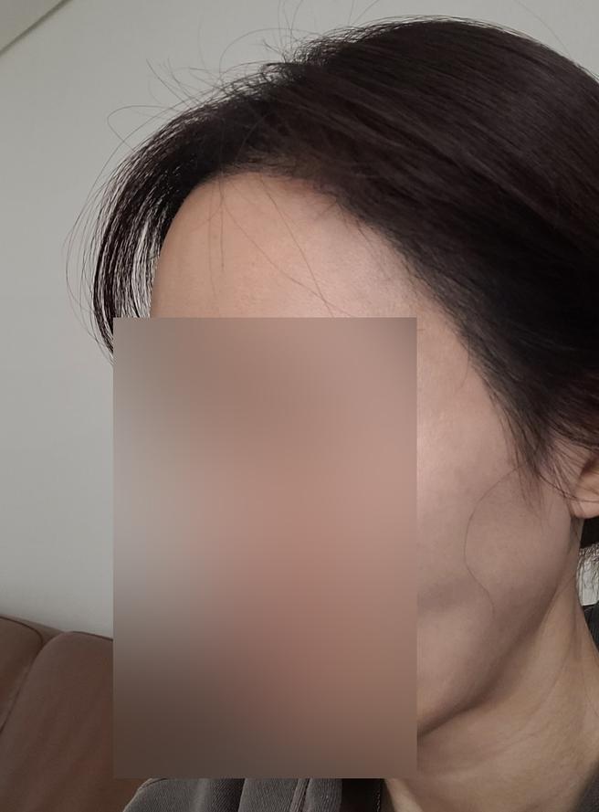 ソウルアイ毛髪移植
