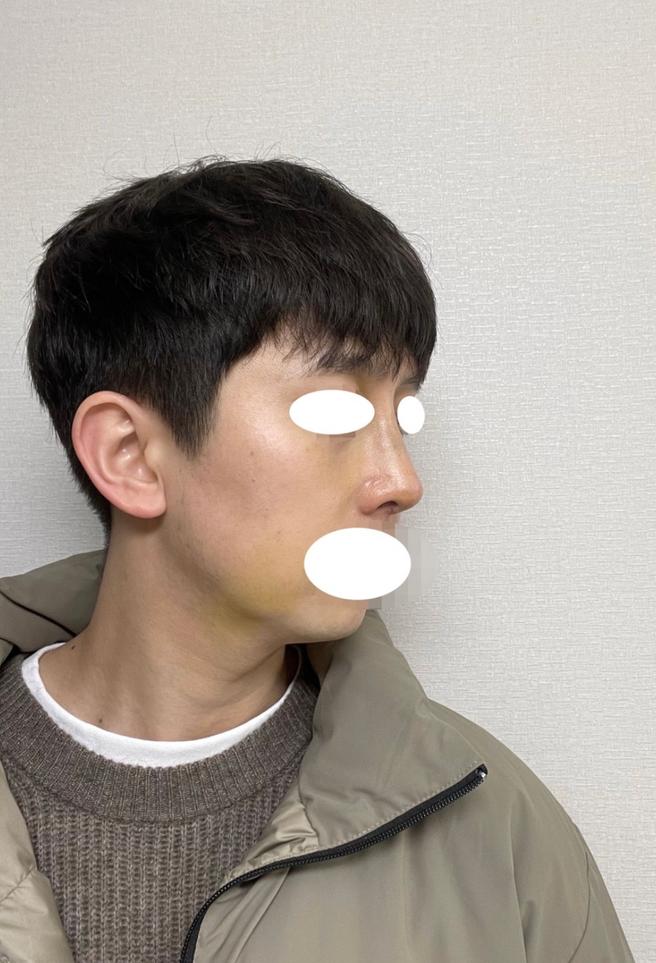 男性隆鼻术