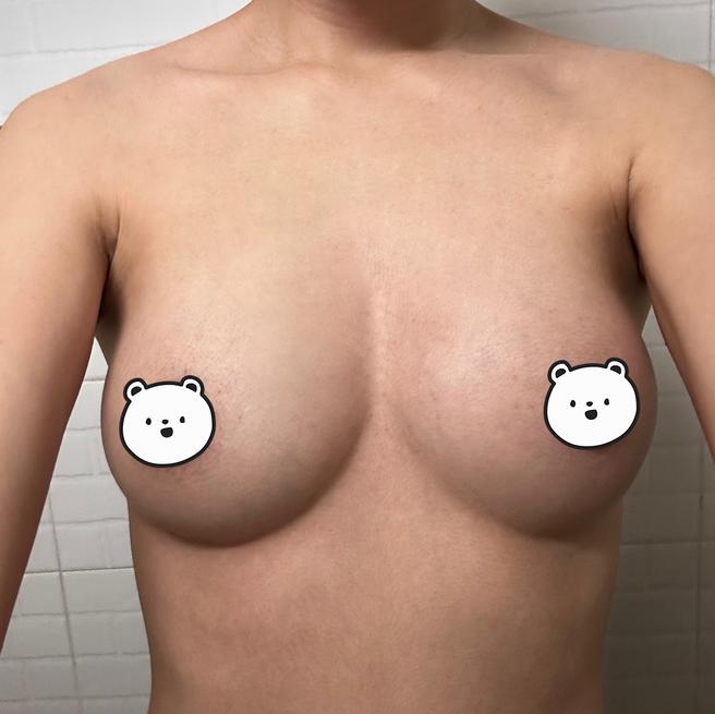 PRPを用いた胸への脂肪移植