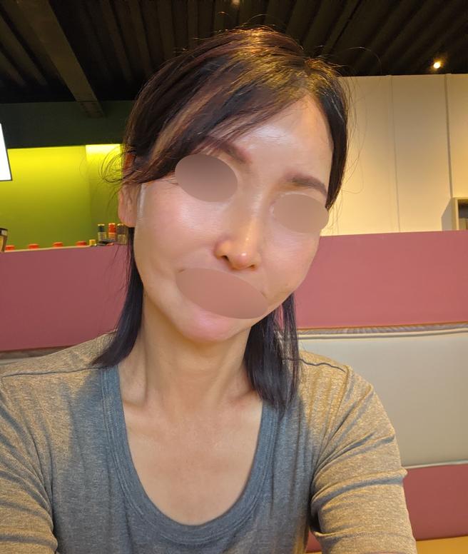 ศัลยกรรมจมูกครั้งแรก