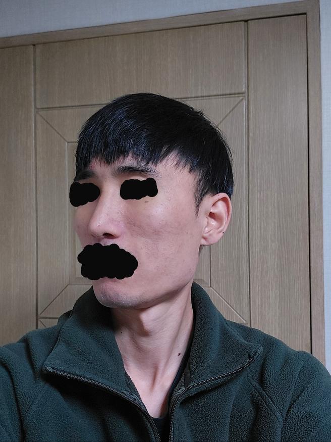 男性隆鼻术