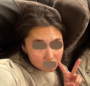 여드름 흉터·모공·이중턱 한번에 잡으러 왔어요~ 리쥬란힐러 솔직 후기