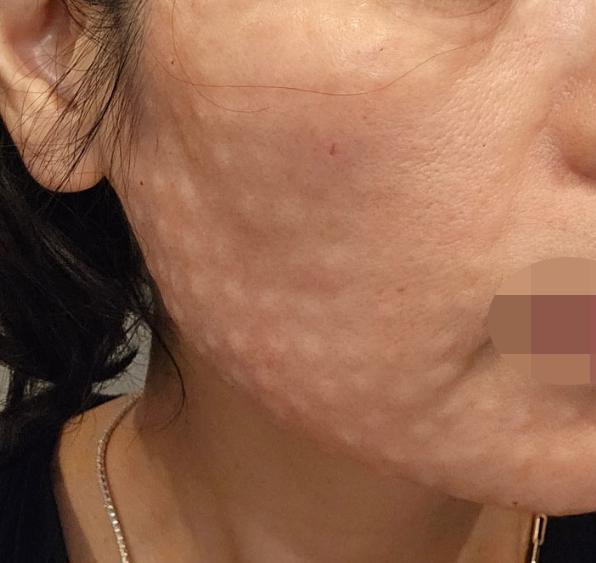 피부 늘어짐이랑 잔주름 고민으로 리쥬란 받아봤어요~