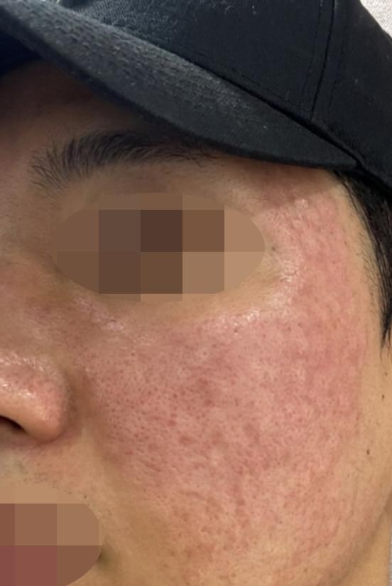 30대 되니 피부 탄력 떨어져서, 리쥬란으로 케어 시작했습니다.