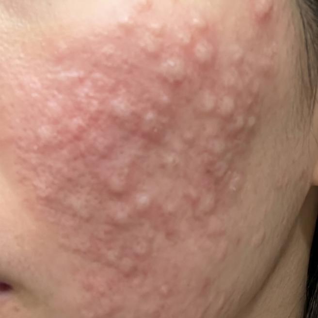 30대 피부 관리 시작, 리쥬란 첫 시술한 당일 후기예요