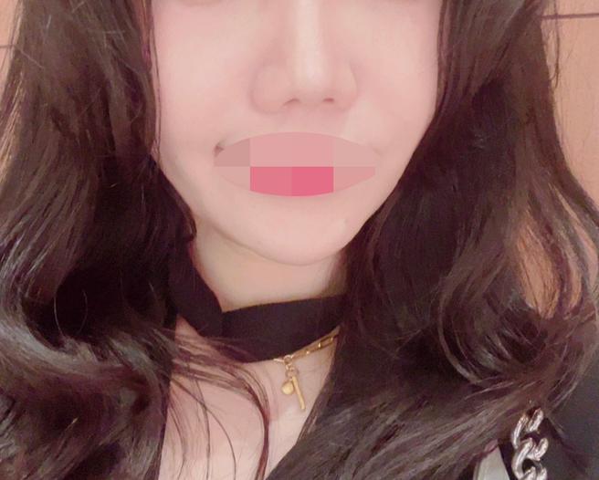 처음이라 걱정했는데 수면으로 편하게 리쥬란힐러 받았어요~