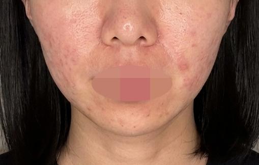 쥬베룩이랑 연어주사 같이 되는 곳 찾다가 수면으로 편하게 받았어요~