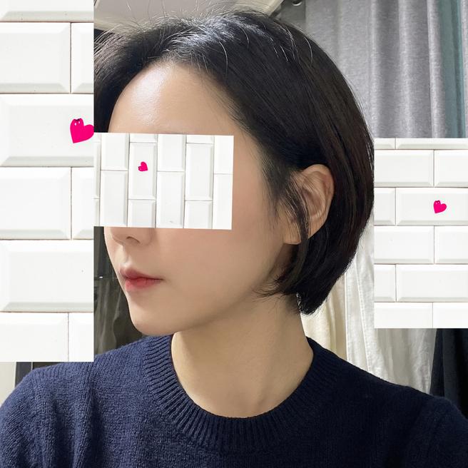  리쥬란 2주차, 피부가 투명하게 맑아진 것 같아서 거울 보는 게 즐거워졌어요