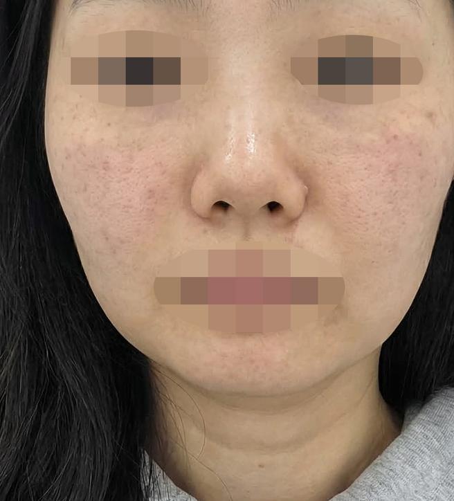 건조해서 리쥬란 받았는데 대기 없고 친절해서 좋았어요!