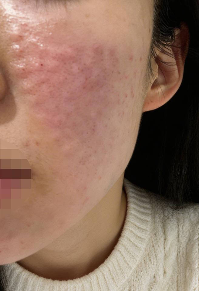 화장 들뜸 고민으로 왔는데 리쥬란이랑 리즈네 같이 받아서 효과 기대돼요~