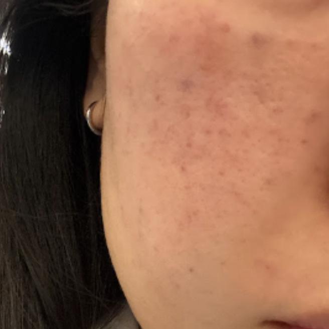리쥬써마 받고 하루 지난 지금 상태 공유해요