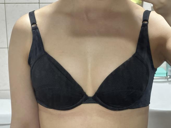 Stem Cell Chest Fat Grafting