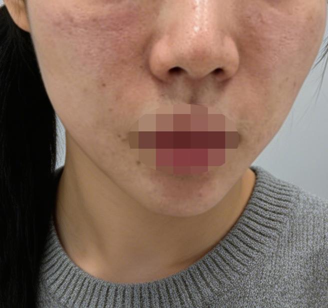 리투오 받았는데 바로 일상 복귀 가능하고 만족이에요~ 그리고 친절하고 꼼꼼해서 편하게 받았습니다!