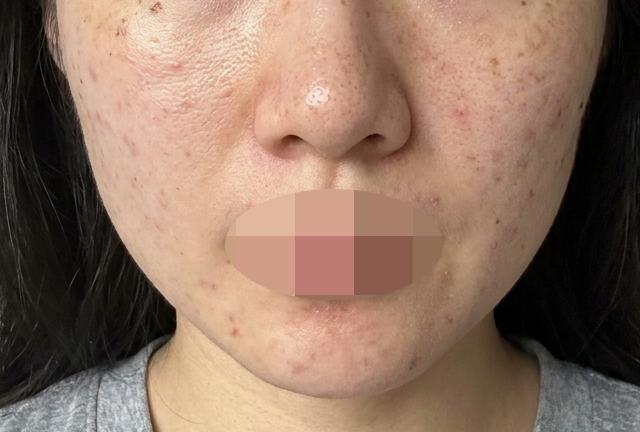 수면으로 받으니 안 아프고 편해서 선택하길 잘했어요ㅎ