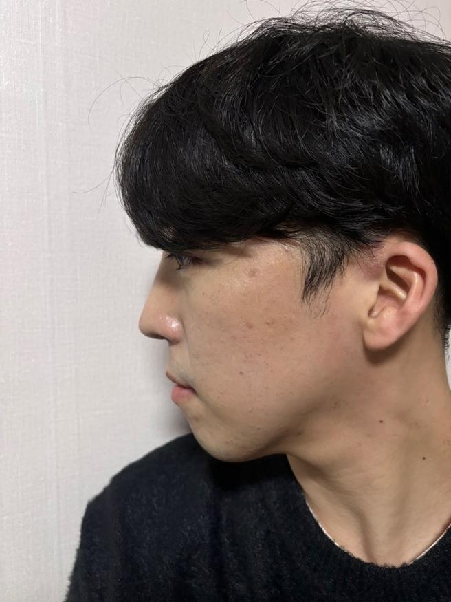 男性眼睛矫正