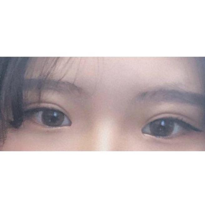 眼幅矯正＆眼瞼下垂