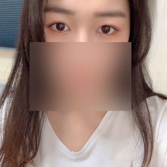 แก้ไขรูปตาและกล้ามเนื้อตาอ่อนแรง