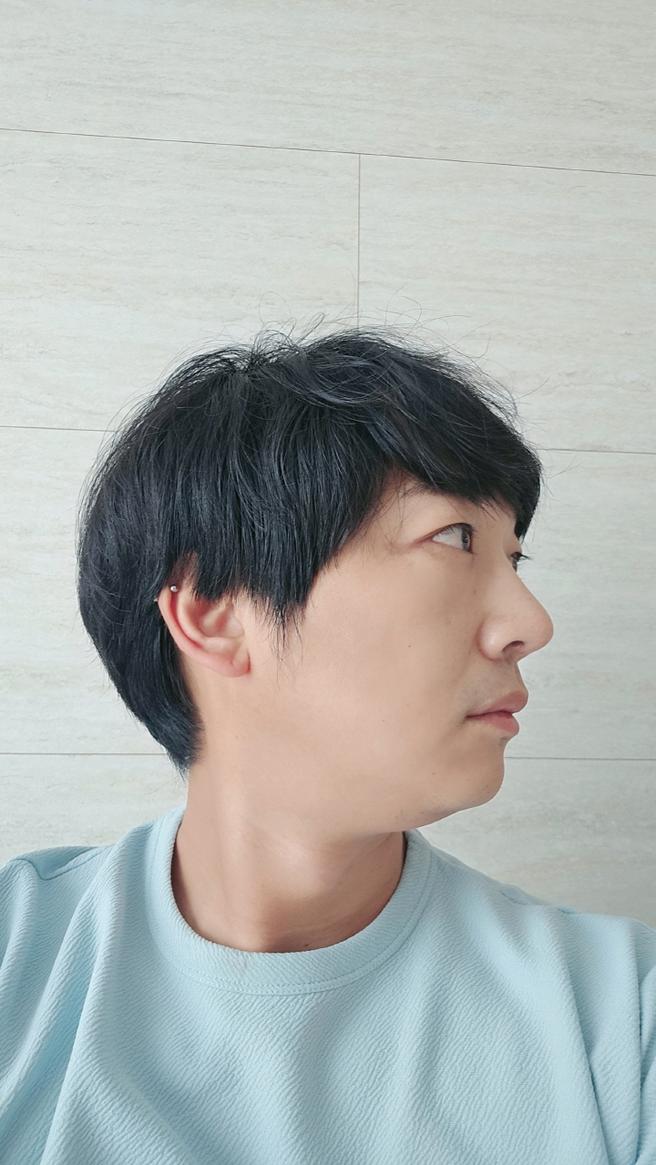 眼下脂肪の再配置