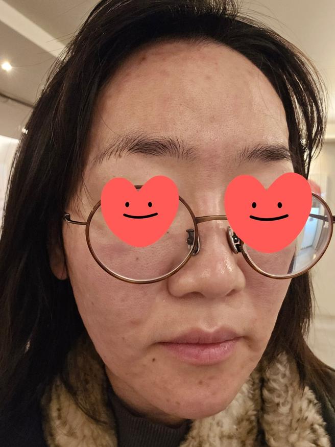 푸석한 피부 살리려고 리쥬란 2회차 맞고 왔어요 (수면 시술 후기)