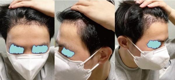 Seoul i Hair Transplant