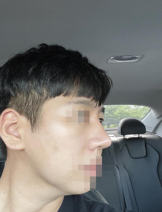 男性鼻整形