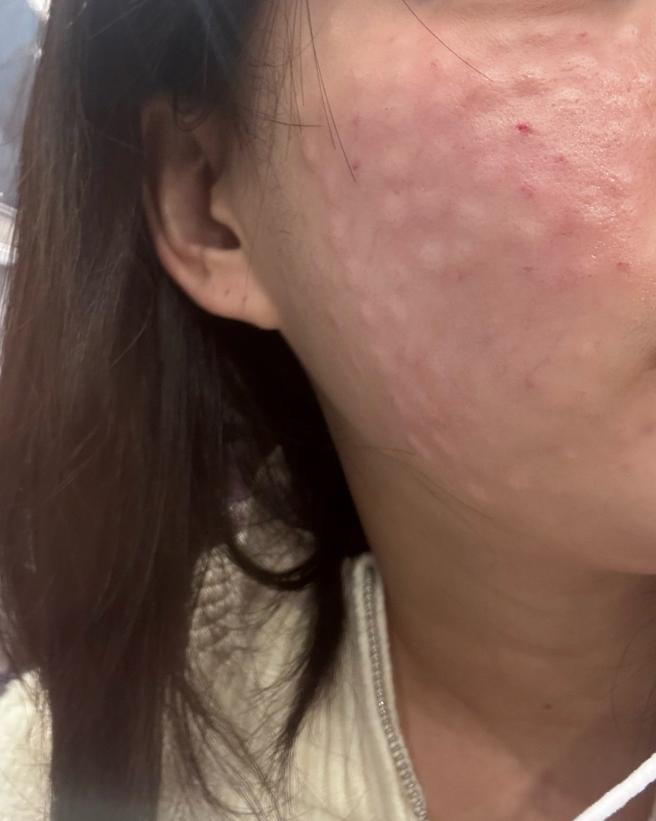 작년에 맞고 효과 좋아서 올해도 쥬베룩! 2일차 지금