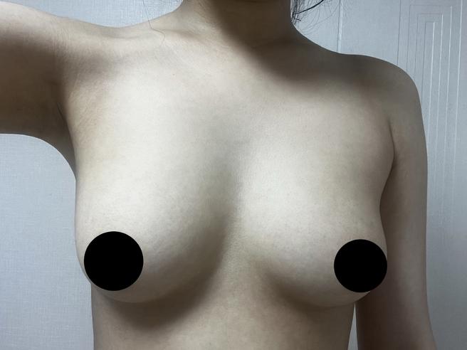 세포 가슴지방이식