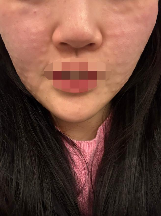리쥬란 처음인데 엠보 잘 나오고 효과 좋을 것 같아서 기대하고 있어요~