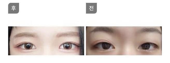 แก้ไขรูปตาและกล้ามเนื้อตาอ่อนแรง