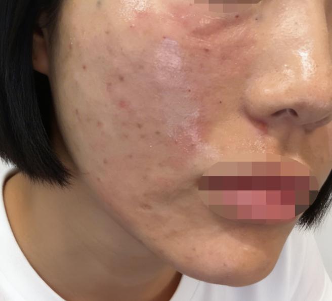 예민한 피부인데 리쥬란 받고 진정되는 느낌이에요~ 일부러 강남역에서 가까운 곳 오길 잘한 것 같아요!