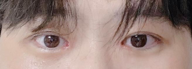 얼굴 지방흡입