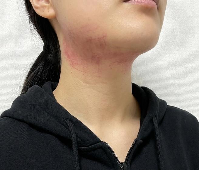 두둑한 얼굴 고민으로  방문했는데 친절한 응대에 꼼꼼한 케어까지, 인모드 받길 잘했어요! 