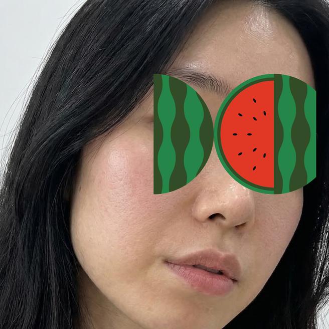 드디어 써마지 맞았어요 ~~ 당일 경과 올려요