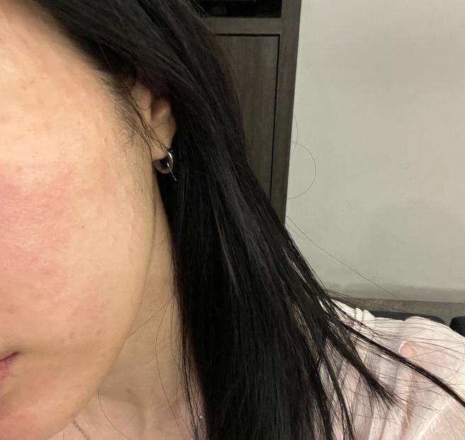 평소 궁금했던 리쥬란, 수분 부족해서 드디어 받아봤어요~ㅎㅎ