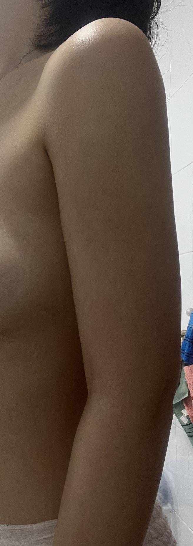 ดูดไขมันตามร่างกาย