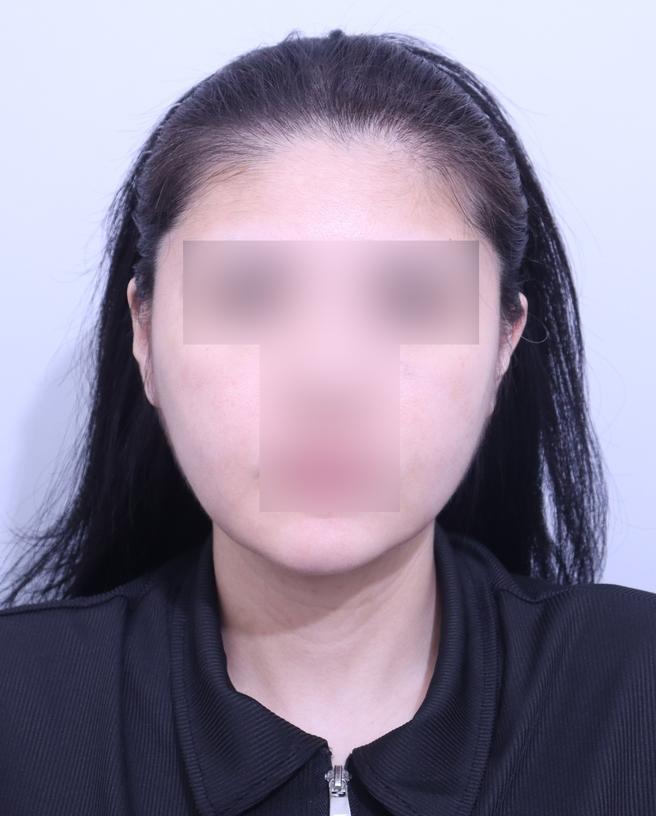 ดูดไขมันใบหน้า