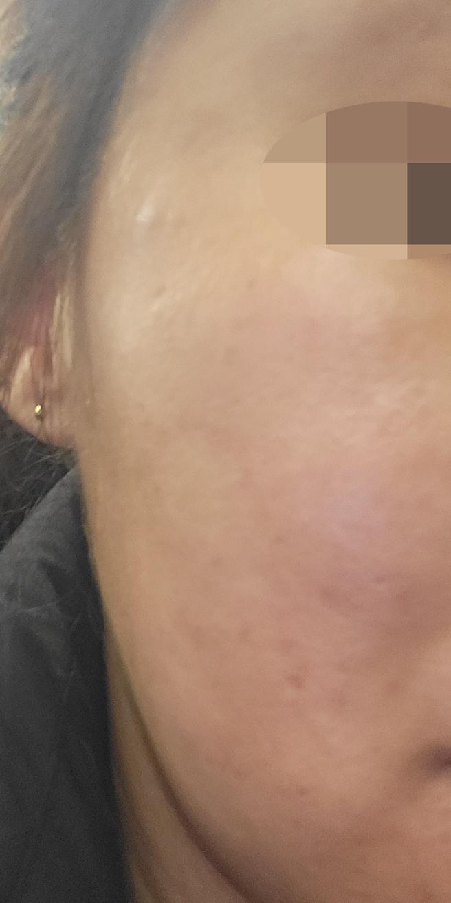 모공 고민으로 받았는데 3개월치 추가 결제하고 왔어요 ㅎㅎ