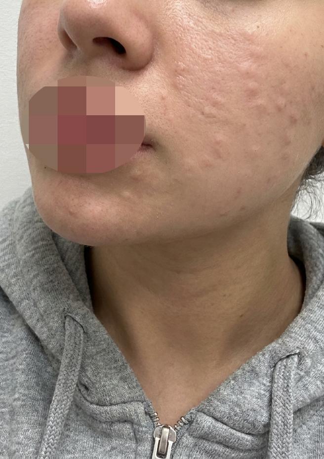 과한 업셀링 없어서 편하게 받은 리쥬란 후기예요~