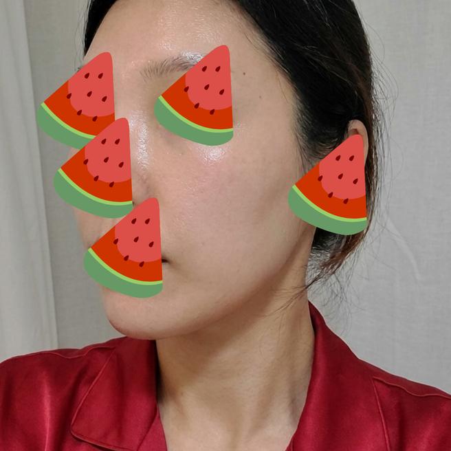 Sculptra 1 ขวด