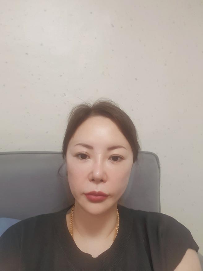 안심 코 재수술