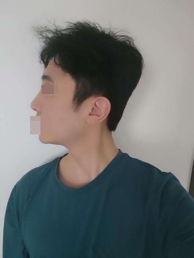 男性隆鼻术