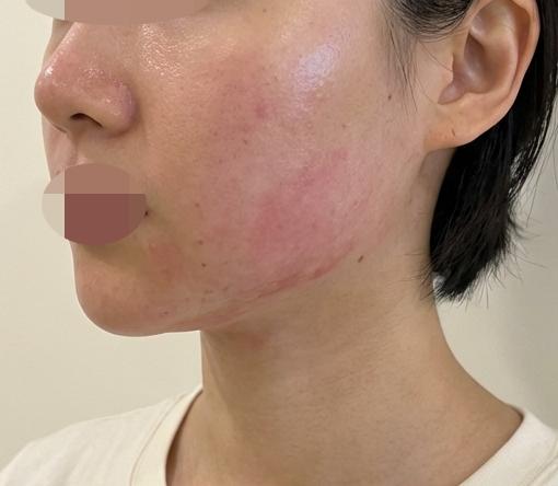 리프팅 고민으로 온다리프팅 수면으로 받으러 방문했어요!